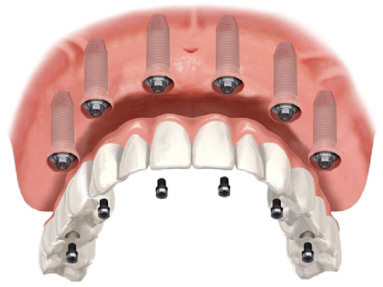 Soins dentaires par pose implant all on 6 en Tunisie : Solution complète pour un sourire parfait
