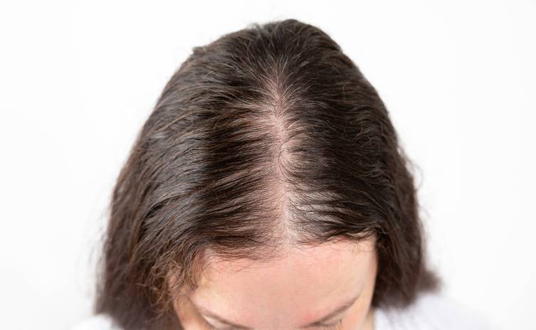 greffe-cheveux-femme-tunisie
