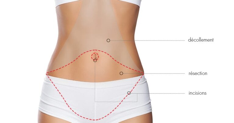 Tarifs abdominoplastie en CHU : Guide complet des coûts et remboursements