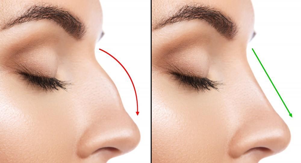 rhinoplastie-france-prix