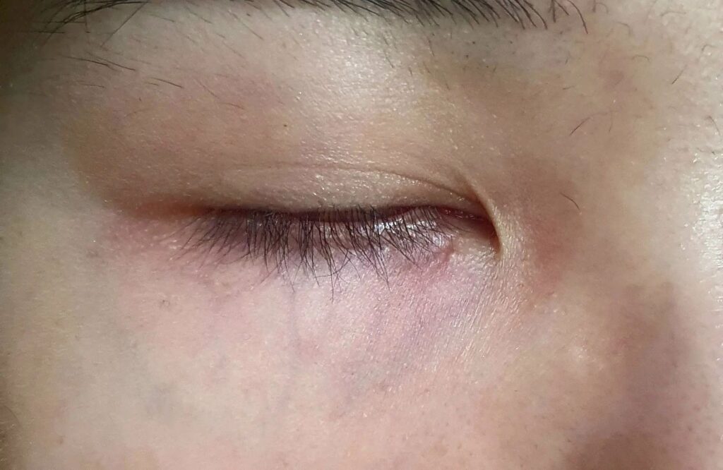Traitement des veines sous les yeux : Méthodes et Conseils Efficaces