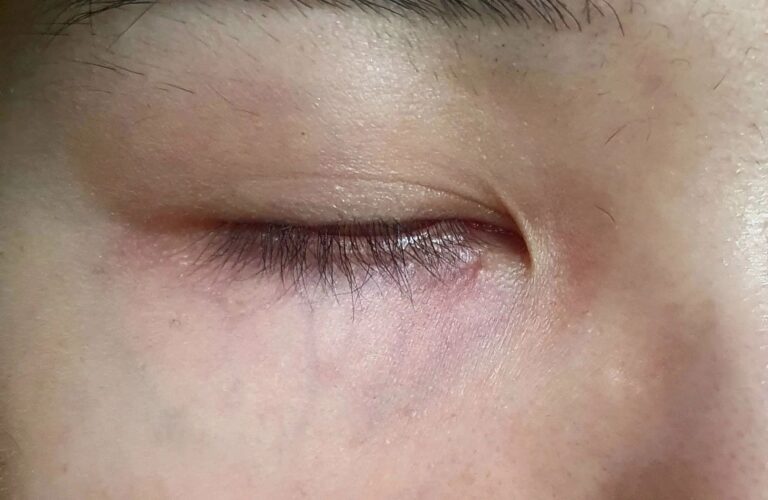 Traitement des veines sous les yeux : Méthodes et Conseils Efficaces