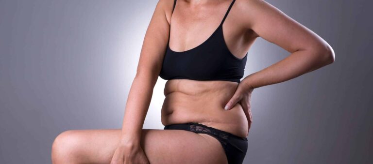 Quel poids pour faire une liposuccion ? Tout ce que vous devez savoir