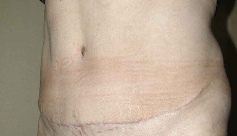 Cicatrice abdominoplastie 1 an après l’opération