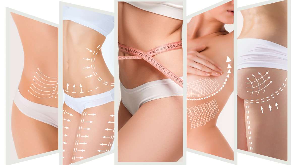 liposuccion-tout-savoir