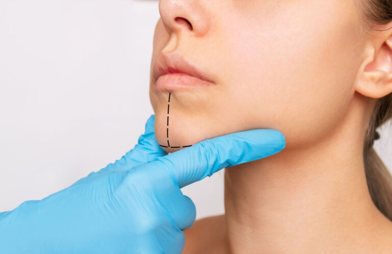 Frais CHU et honoraires chirurgie mentoplastie en France