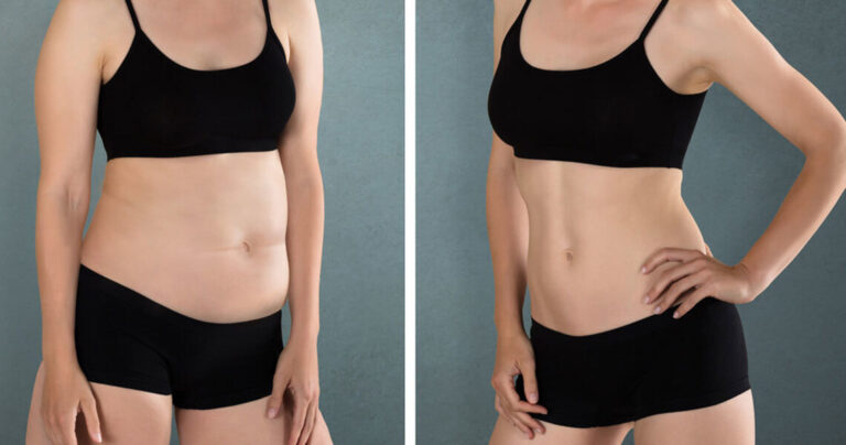 Chirurgie Esthétique Mini-Abdominoplastie en Turquie : Tarif, Déroulement et Résultat