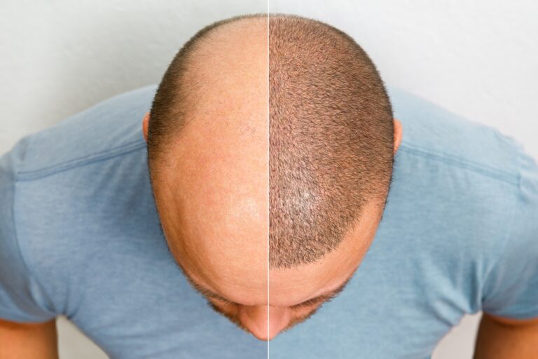 Chirurgie Esthétique des Cheveux : Greffe Capillaire DHI en Turquie