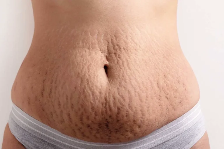 Quel est le prix d’une liposuccion du ventre en Turquie ? Coûts et informations utiles