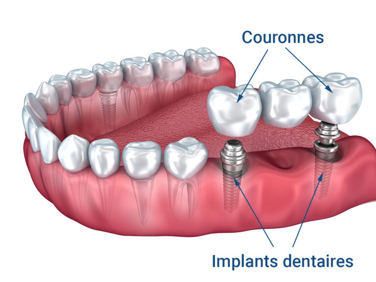 La Chirurgie de Pose de Pont sur Implant en Turquie : Un Guide Complet