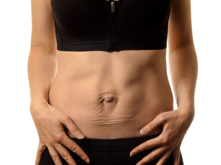 Chirurgie esthétique du ventre avec diatasis en France