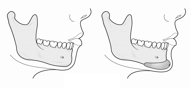 genioplastie hongrie
