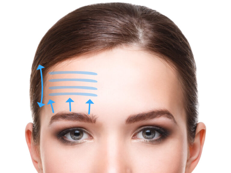 Lifting frontal en France : tout ce que vous devez savoir