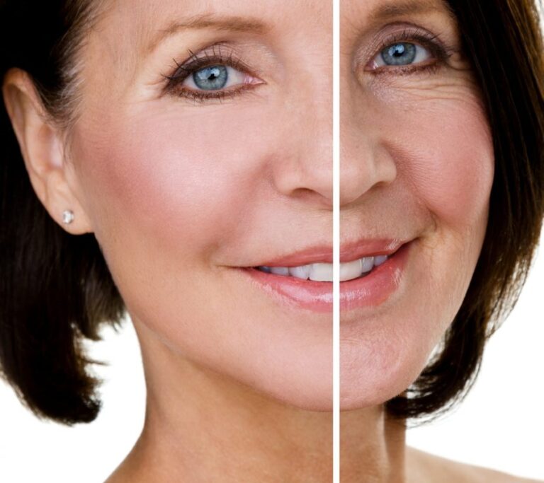 Mini-lifting du visage en France : prix de cette chirurgie esthétique
